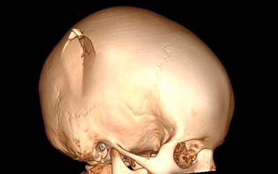 Вдавленные переломы костей черепа