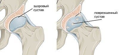 Коксартроз