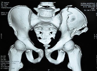 КТ костей таза в клинике ЦЭЛТ в Москве