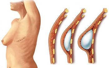 Эндопротезирование молочных желез с мастопексией в клинике ЦЭЛТ в Москве