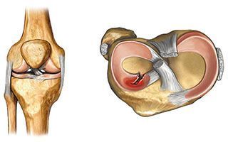 Артроскопическая пластика задней крестообразной связки коленного сустава (без учета стоимости расходного материала) (I категория сложности) в клинике ЦЭЛТ в Москве