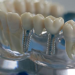 Изготовление балочной конструкции с винтовой фиксацией на имплантах в клинике ЦЭЛТ в Москве