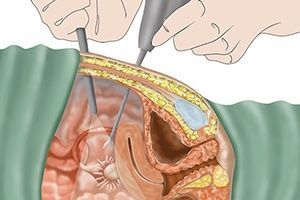 Лапароскопическое удаление миомы матки в клинике ЦЭЛТ в Москве