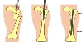 Остеосинтез мелких трубчатых костей (I категория сложности) в клинике ЦЭЛТ в Москве