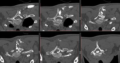 Контрастная фистулография желчных протоков в клинике ЦЭЛТ в Москве