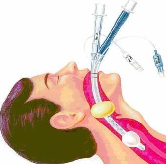 Интубация трахеи в клинике ЦЭЛТ в Москве