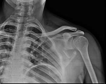 Рентгенография лопатки в клинике ЦЭЛТ в Москве