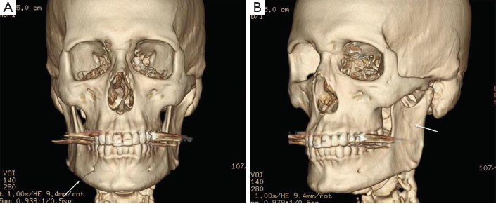 КТ костей лицевого скелета в клинике ЦЭЛТ в Москве