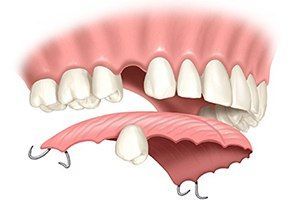 Пластиночные протезы  в клинике ЦЭЛТ в Москве