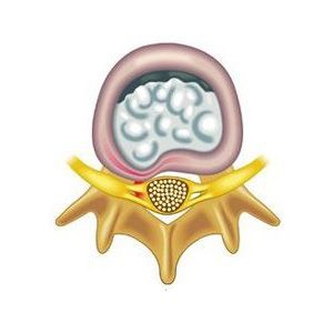 Протрузия межпозвонковых дисков шейного отдела позвоночника