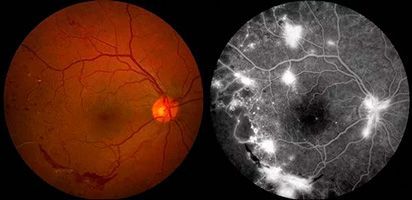 Флуоресцентная ангиография сетчатки в клинике ЦЭЛТ в Москве
