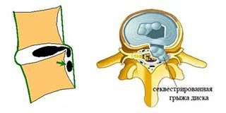 Секвестрированная грыжа диска в клинике ЦЭЛТ в Москве