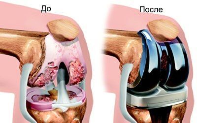 Гонартроз 3 степени коленного сустава