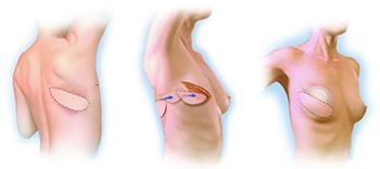 Удаление имплантов груди в клинике ЦЭЛТ в Москве