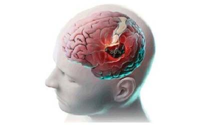 Черепно-мозговая травма