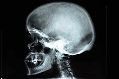 Рентген носоглотки при аденоидах в клинике ЦЭЛТ в Москве