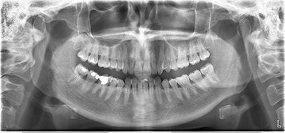 Панорамный снимок зуба в клинике ЦЭЛТ в Москве