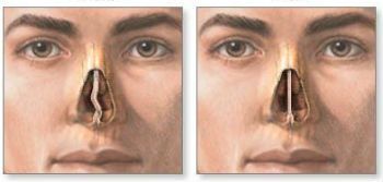 Септопластика (I категория сложности) в клинике ЦЭЛТ в Москве