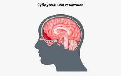Субдуральные гематомы головного мозга