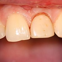 Периодонтит