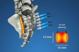Блокада крестцово-подвздошного сочленения в клинике ЦЭЛТ в Москве