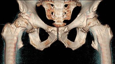Компьютерная томография тазобедренного сустава в клинике ЦЭЛТ в Москве