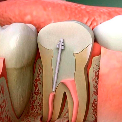 Удаление инородного тела (из корневого канала) в клинике ЦЭЛТ в Москве