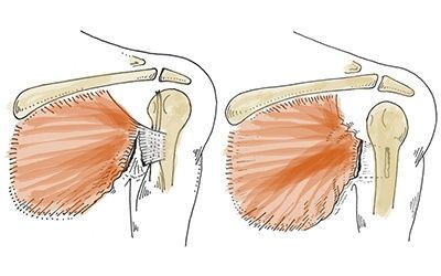 Разрыв мышц