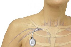 Венозные порт-системы для инфузий в клинике ЦЭЛТ в Москве