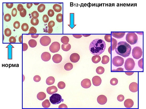 Витамин В12-дефицитная анемия