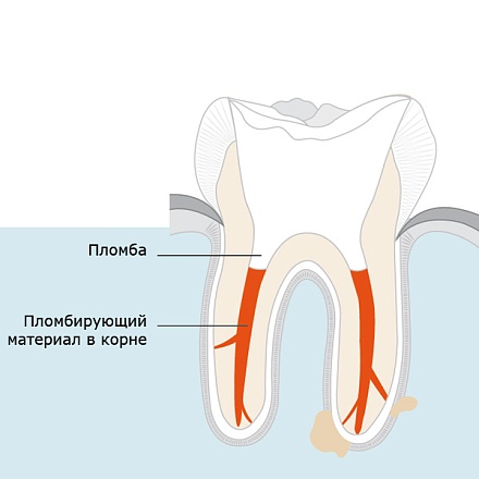Обтурация корневого каналов комбинированной методикой с использованием термопластической гуттаперчи (1 канал) в клинике ЦЭЛТ в Москве