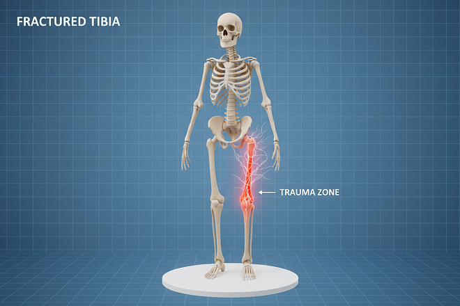 Субакромиальная декомпрессия (I категория сложности) в клинике ЦЭЛТ в Москве