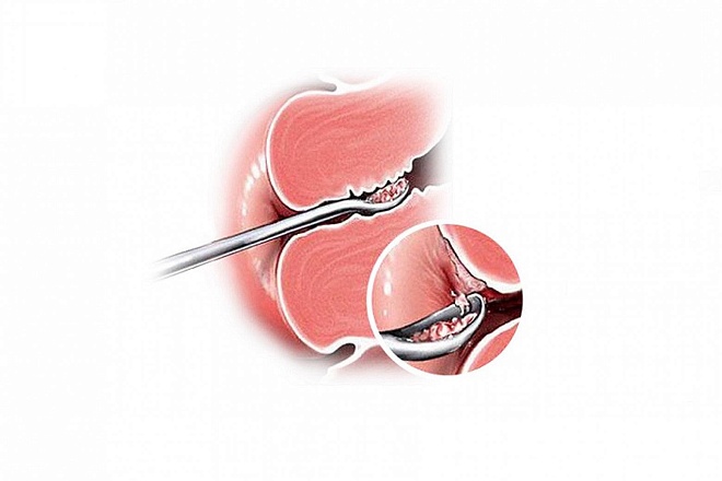 Бужирование уретры в клинике ЦЭЛТ в Москве