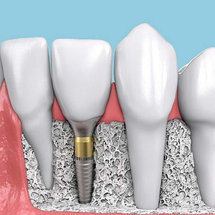 Удаление импланта зуба в клинике ЦЭЛТ в Москве