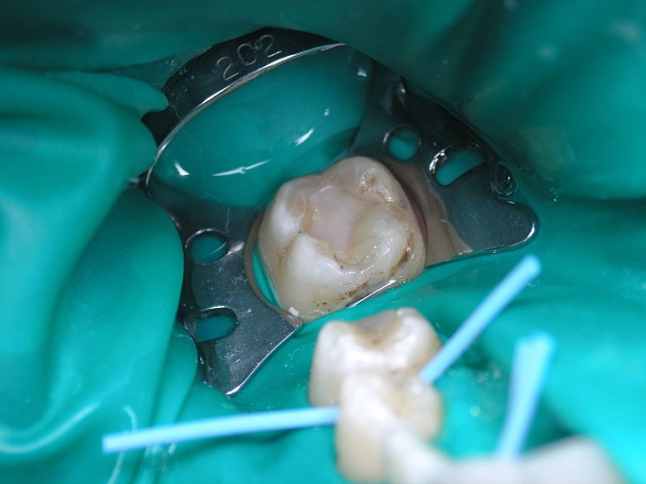 Лечебная прокладка при лечении глубокого кариеса в клинике ЦЭЛТ в Москве